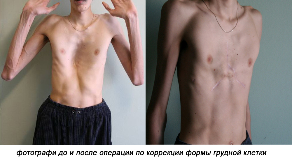 фотографи до и после операции по коррекции формы грудной клетки